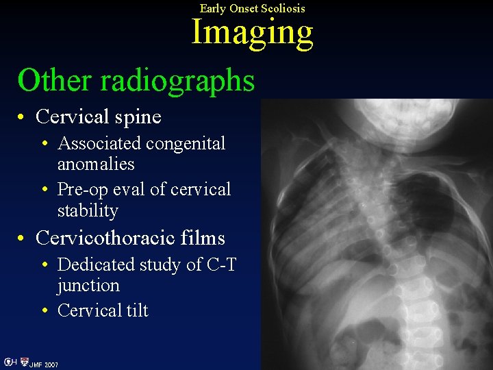 Early Onset Scoliosis Imaging Other radiographs • Cervical spine • Associated congenital anomalies •