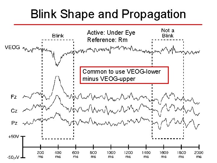 Blink Shape and Propagation Active: Under Eye Reference: Rm Common to use VEOG-lower minus