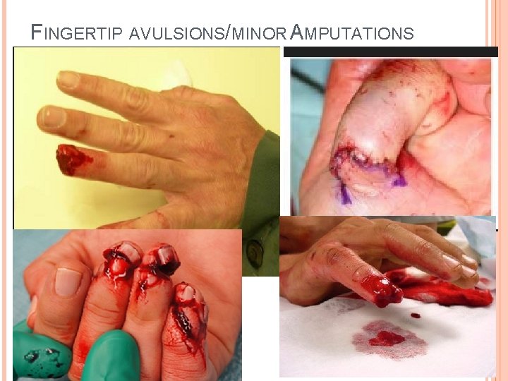 FINGERTIP AVULSIONS/MINOR AMPUTATIONS 