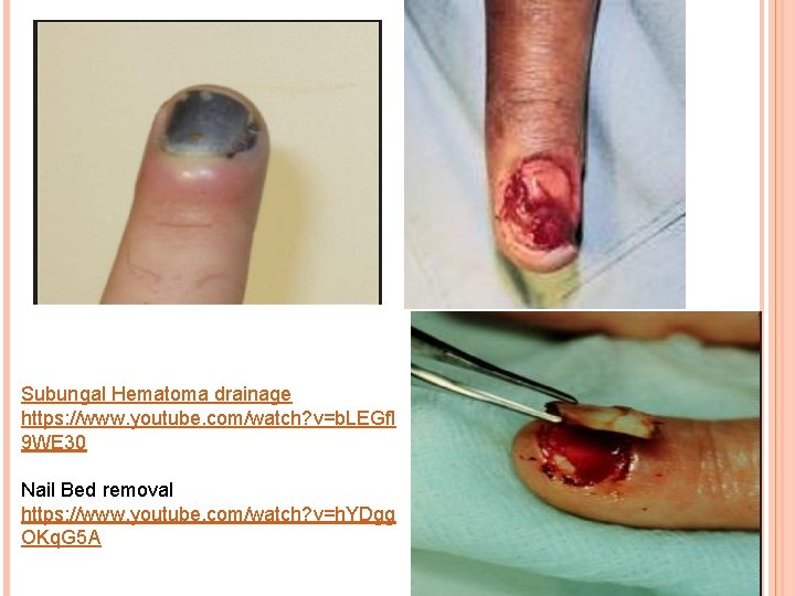 Subungal Hematoma drainage https: //www. youtube. com/watch? v=b. LEGfl 9 WE 30 Nail Bed