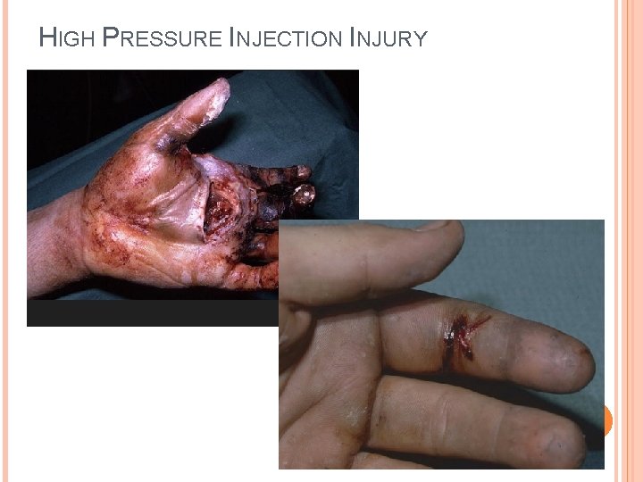 HIGH PRESSURE INJECTION INJURY 