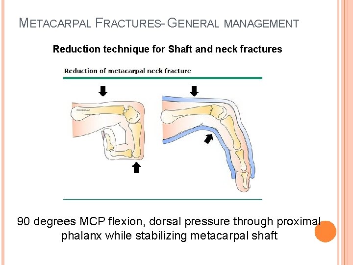 METACARPAL FRACTURES- GENERAL MANAGEMENT Reduction technique for Shaft and neck fractures 90 degrees MCP