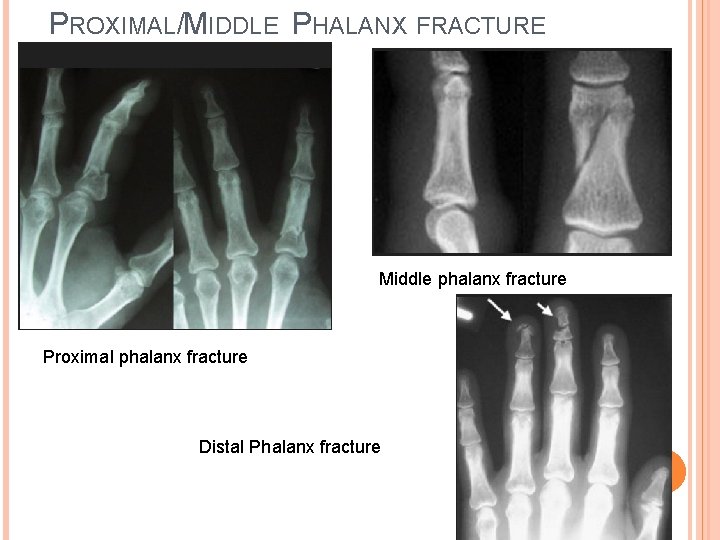 PROXIMAL/MIDDLE PHALANX FRACTURE Middle phalanx fracture Proximal phalanx fracture Distal Phalanx fracture 