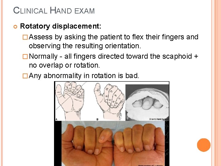 CLINICAL HAND EXAM Rotatory displacement: � Assess by asking the patient to flex their