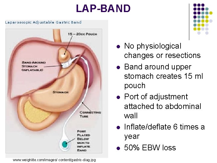 LAP-BAND l l l www. weighlite. com/images/ content/gastric-diag. jpg No physiological changes or resections