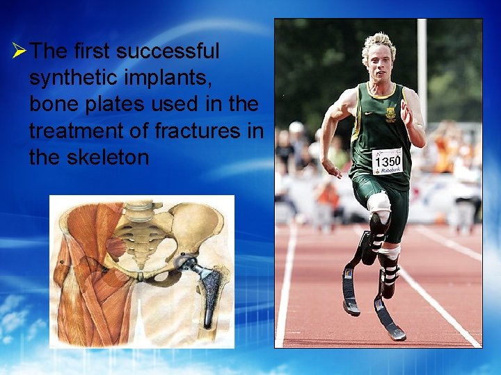  The first successful synthetic implants, bone plates used in the treatment of fractures