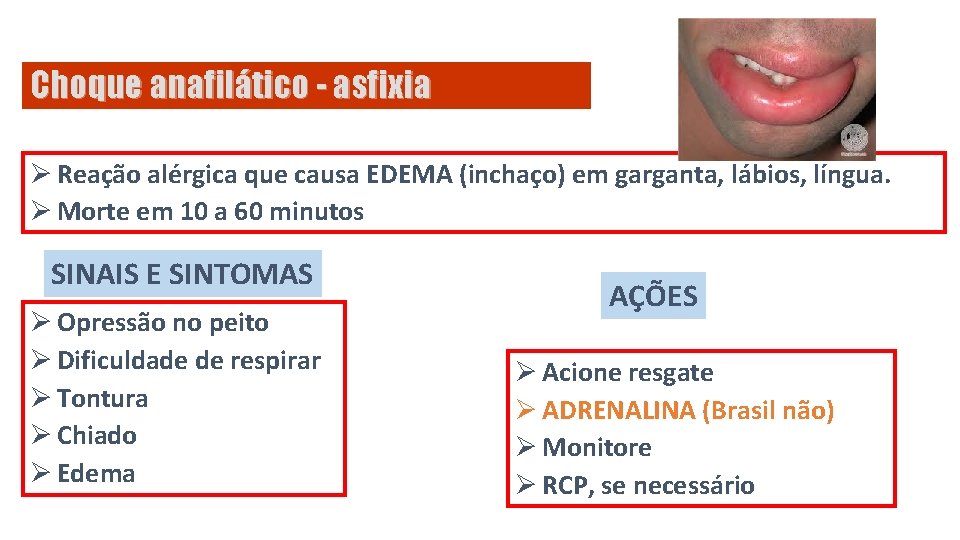 Choque anafilático - asfixia Ø Reação alérgica que causa EDEMA (inchaço) em garganta, lábios,
