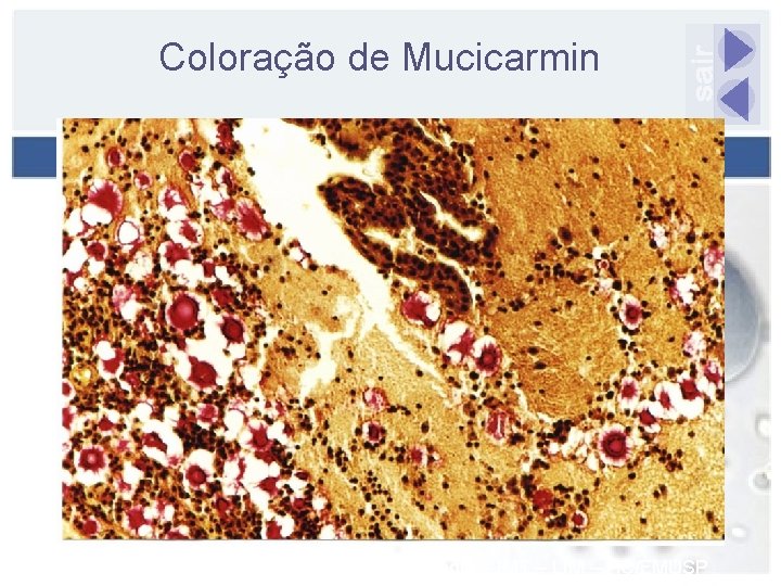 Coloração de Mucicarmin Fonte: Laboratório de Micologia – IMT – LIM – HC/FMUSP 