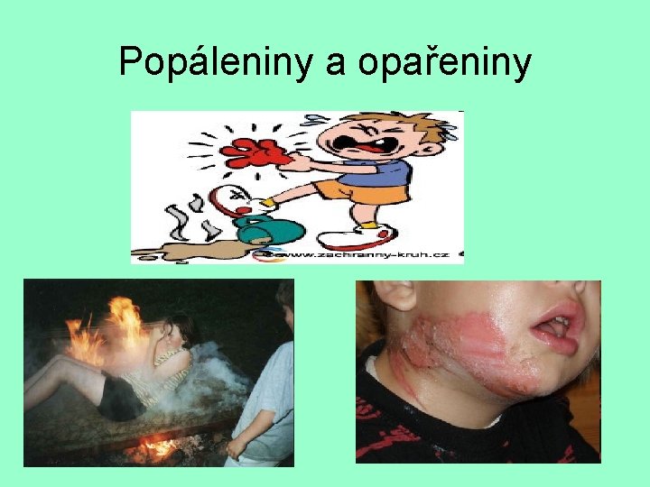 Popáleniny a opařeniny 