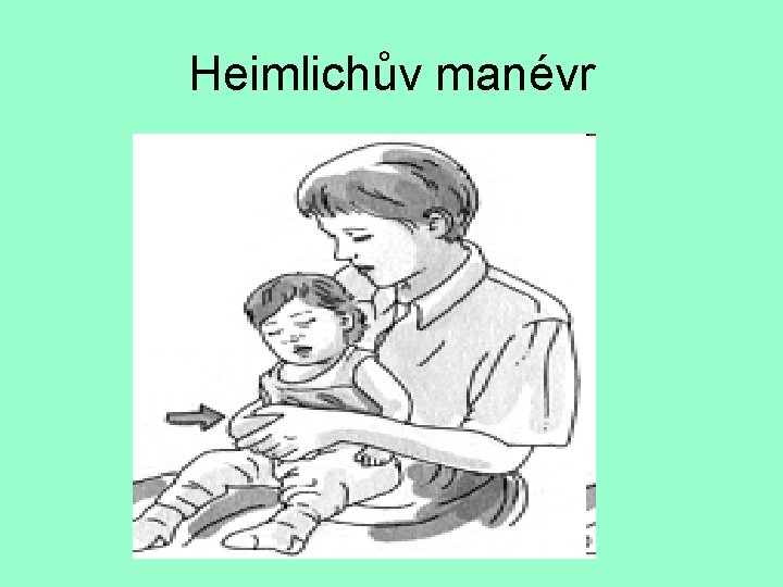 Heimlichův manévr 