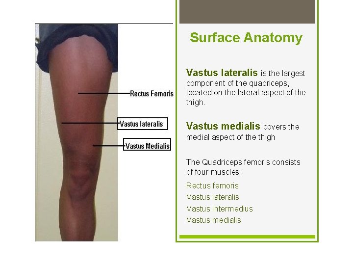 Surface Anatomy Vastus lateralis is the largest component of the quadriceps, located on the