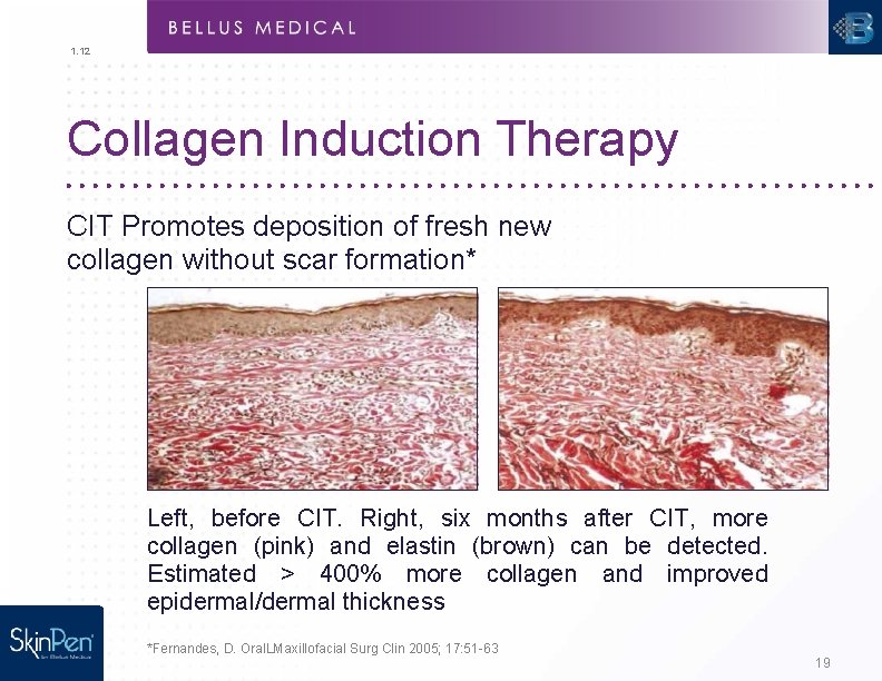 1. 12 Collagen Induction Therapy CIT Promotes deposition of fresh new collagen without scar