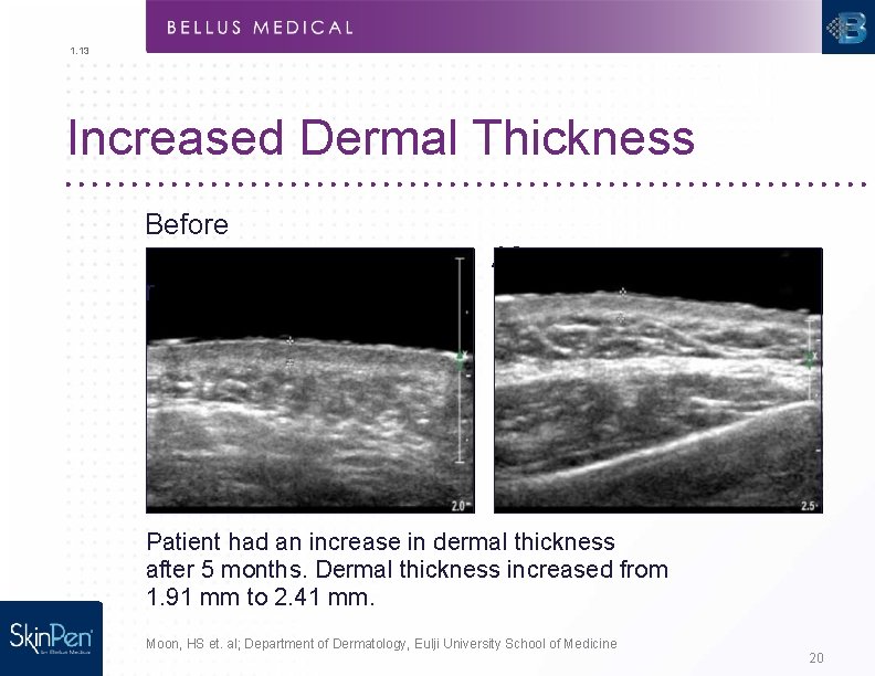 1. 13 Increased Dermal Thickness Before Afte r Patient had an increase in dermal
