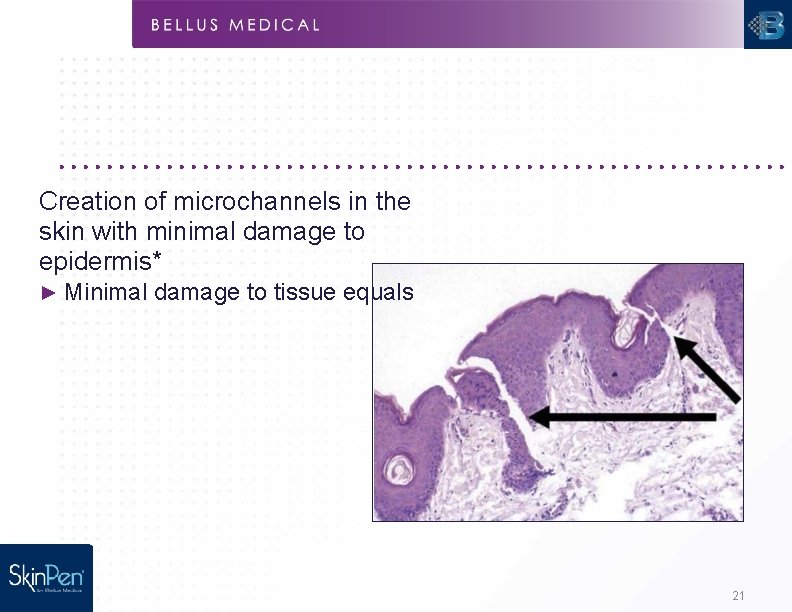 Creation of microchannels in the skin with minimal damage to epidermis* ► Minimal damage