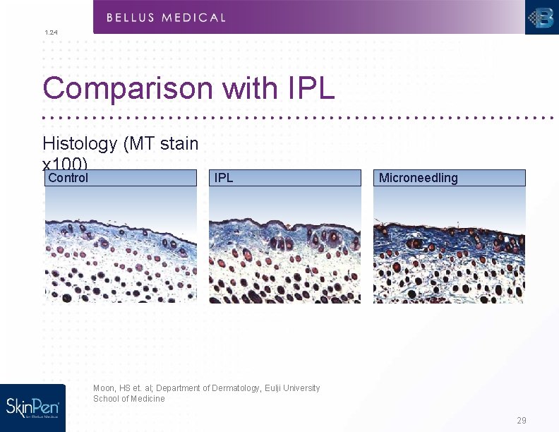 1. 24 Comparison with IPL Histology (MT stain x 100) Control IPL Microneedling Moon,