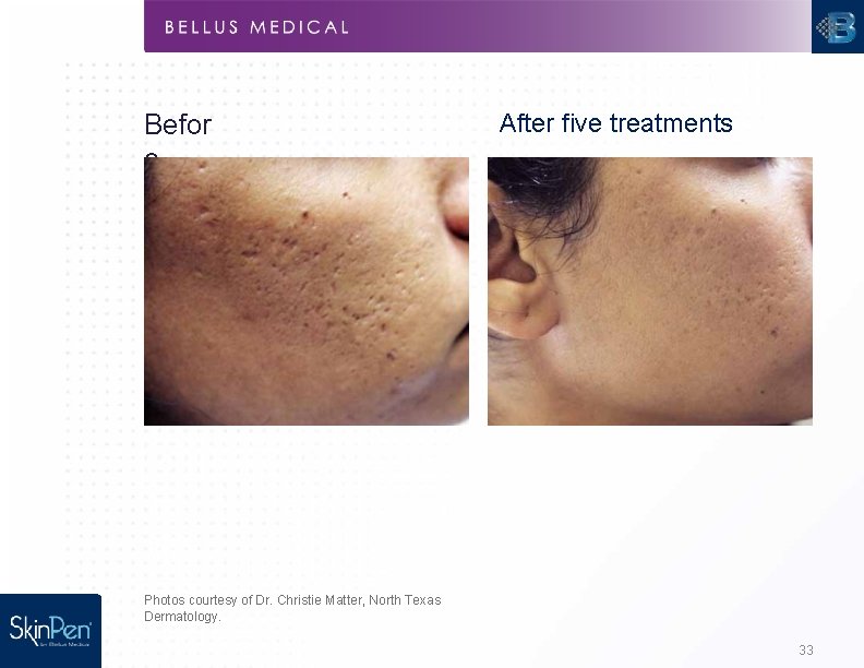 Befor e After five treatments Photos courtesy of Dr. Christie Matter, North Texas Dermatology.