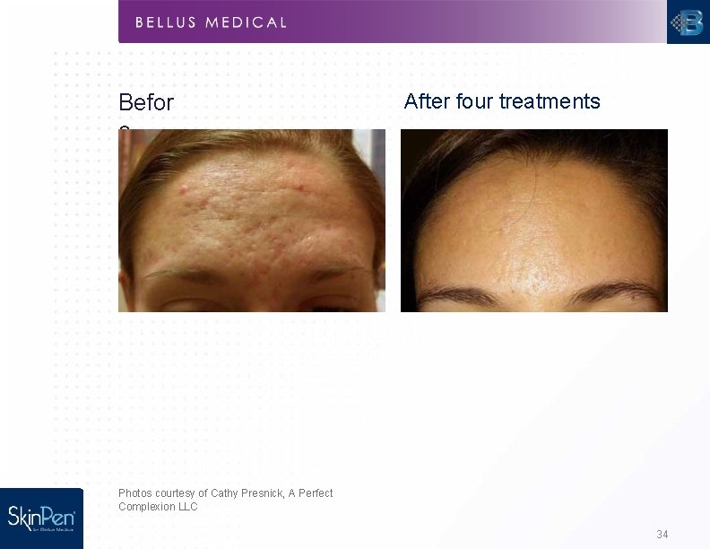 Befor e After four treatments Photos courtesy of Cathy Presnick, A Perfect Complexion LLC