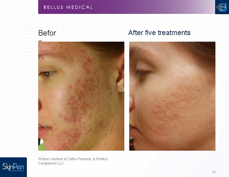 Befor e After five treatments Photos courtesy of Cathy Presnick, A Perfect Complexion LLC