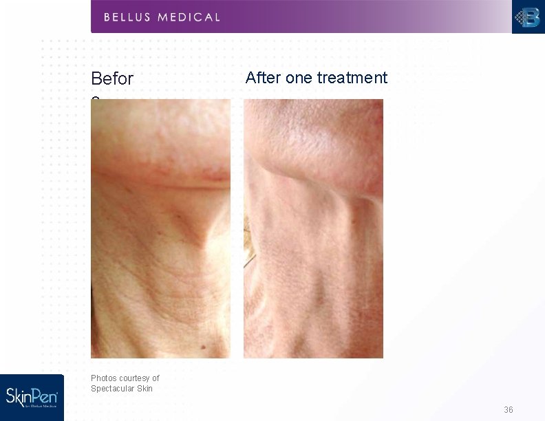 Befor e After one treatment Photos courtesy of Spectacular Skin 36 