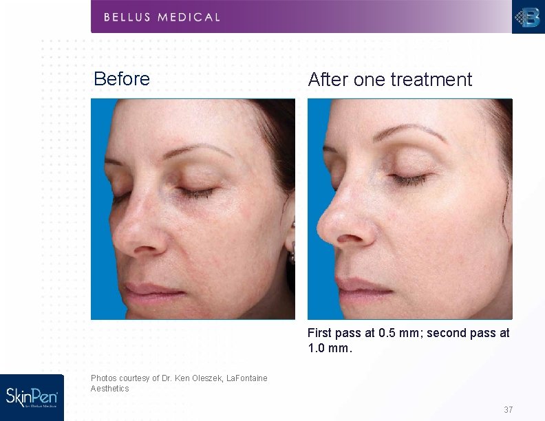 Before After one treatment First pass at 0. 5 mm; second pass at 1.