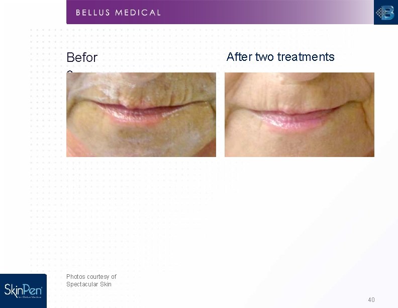 Befor e After two treatments Photos courtesy of Spectacular Skin 40 
