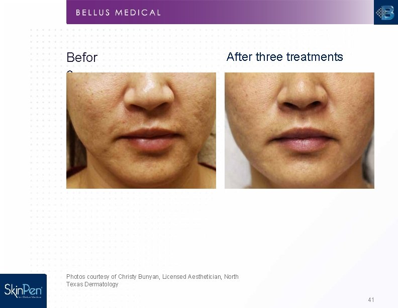Befor e After three treatments Photos courtesy of Christy Bunyan, Licensed Aesthetician, North Texas
