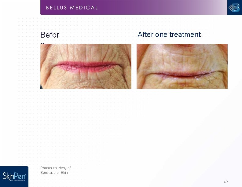 Befor e After one treatment Photos courtesy of Spectacular Skin 42 