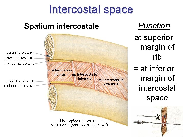 Intercostal space Punction at superior margin of rib = at inferior margin of intercostal