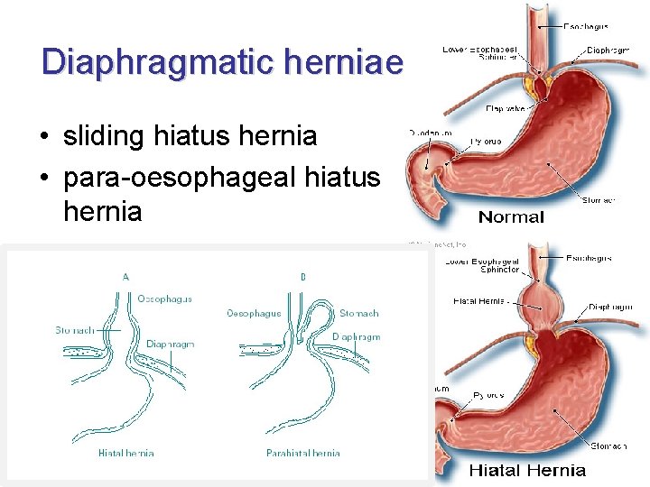 Diaphragmatic herniae • sliding hiatus hernia • para-oesophageal hiatus hernia 
