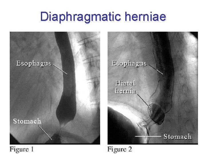 Diaphragmatic herniae 