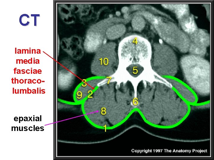 CT lamina media fasciae thoracolumbalis epaxial muscles 