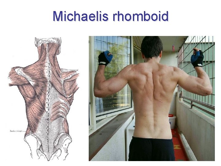 Michaelis rhomboid 