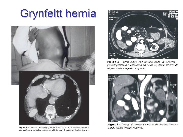 Grynfeltt hernia 