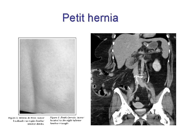 Petit hernia 