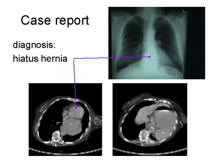 Case report diagnosis: hiatus hernia 