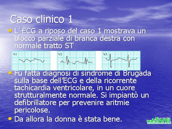 Caso clinico 1 • L’ ECG a riposo del caso 1 mostrava un blocco