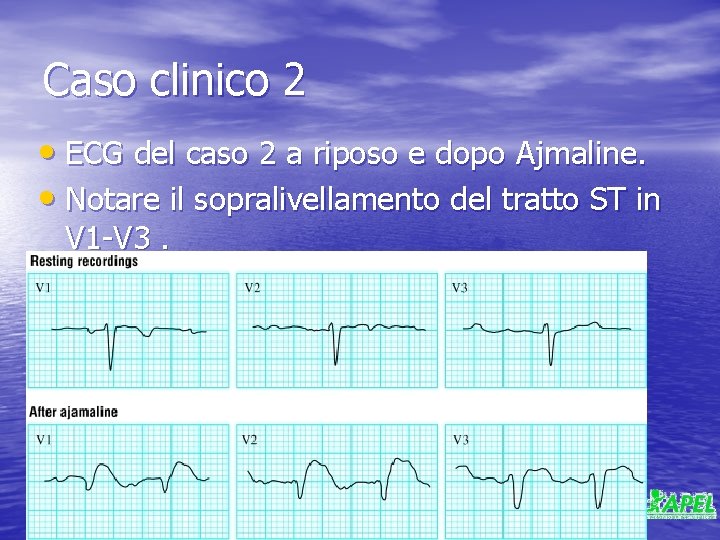 Caso clinico 2 • ECG del caso 2 a riposo e dopo Ajmaline. •
