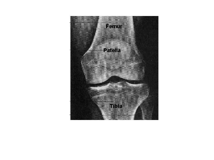 Femur Patella Tibia 