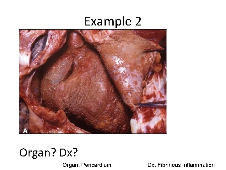 Example 2 Organ? Dx? Organ: Pericardium Dx: Fibrinous Inflammation 