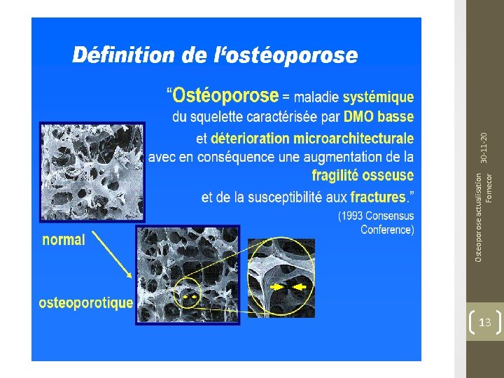 13 Osteoporose actualisation Fomecor 30 -11 -20 