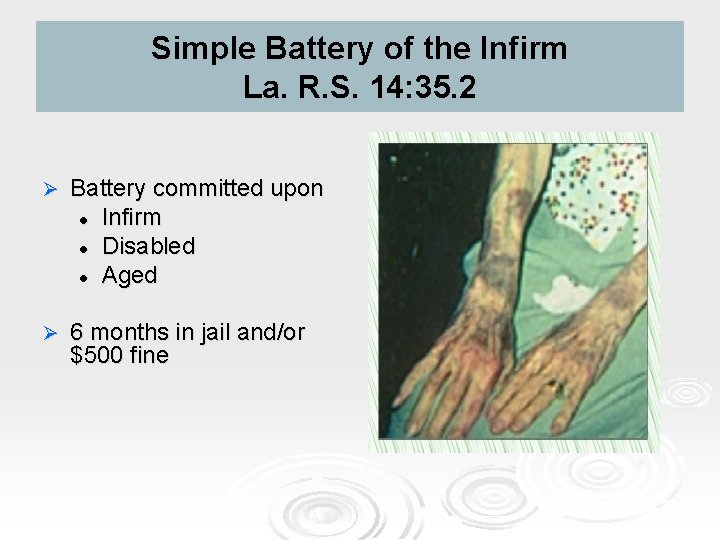 Simple Battery of the Infirm La. R. S. 14: 35. 2 Ø Battery committed