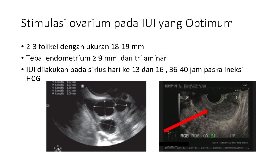 Stimulasi ovarium pada IUI yang Optimum • 2 -3 folikel dengan ukuran 18 -19