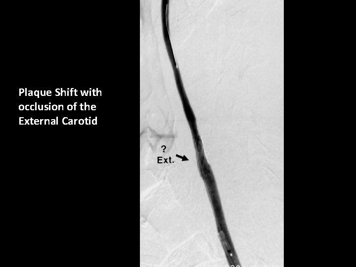 Plaque Shift with occlusion of the External Carotid 