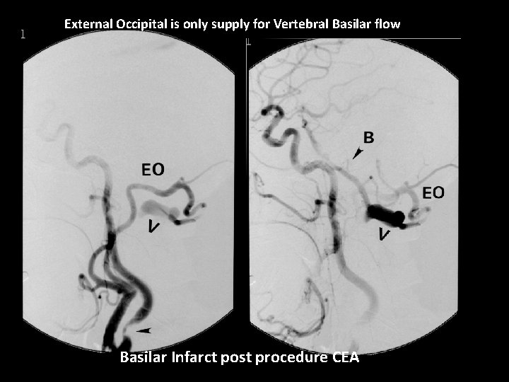 External Occipital is only supply for Vertebral Basilar flow Basilar Infarct post procedure CEA