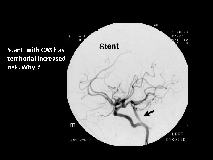 Stent with CAS has territorial increased risk. Why ? 