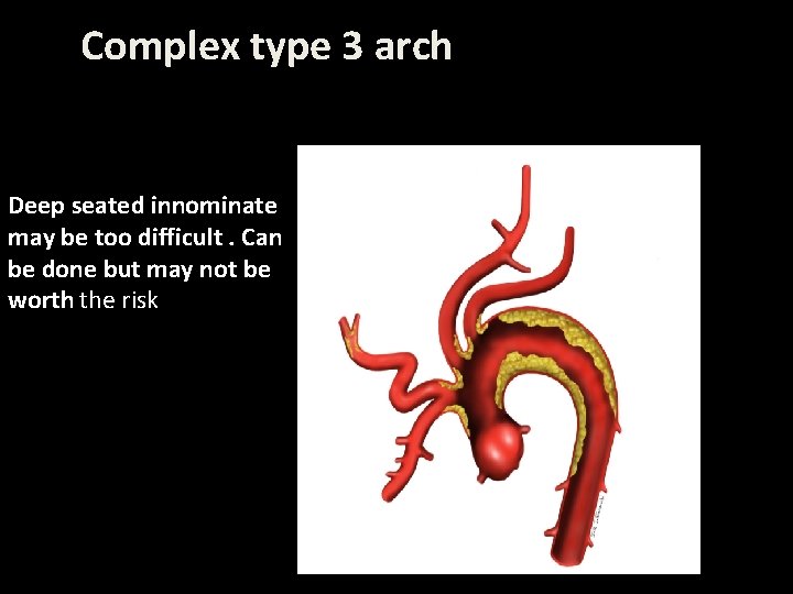 Complex type 3 arch Deep seated innominate may be too difficult. Can be done