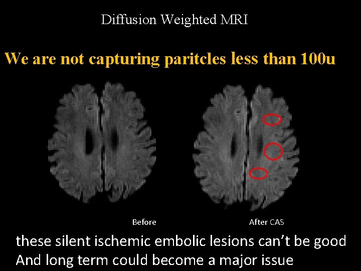 Diffusion Weighted MRI We are not capturing paritcles less than 100 u Before After