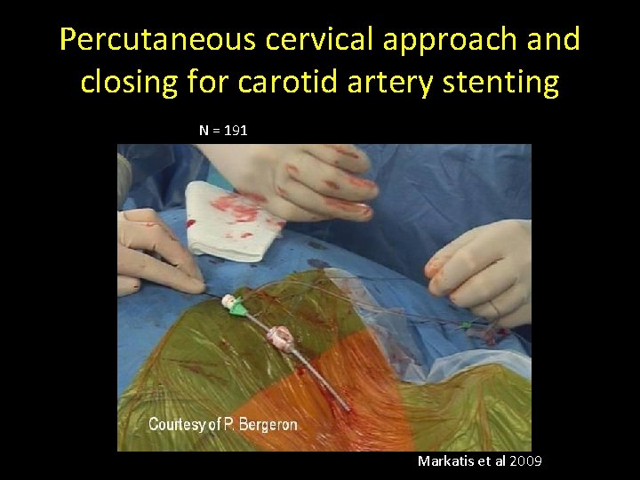Percutaneous cervical approach and closing for carotid artery stenting N = 191 Markatis et