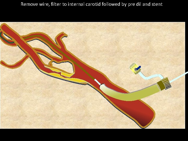 Remove wire, filter to internal carotid followed by pre dil and stent 
