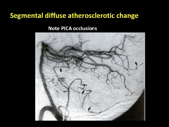 Segmental diffuse atherosclerotic change Note PICA occlusions 